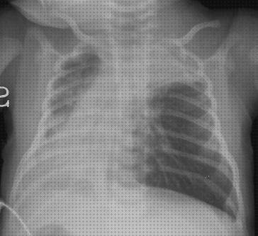 Las mejores nebulizador bronquiolitis Más sobre nebulizador c28p Más sobre nebulizador esencias nebulizador suero bronquiolitis